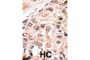 Formalin-fixed and paraffin-embedded human hepatocellular carcinoma tissue reacted with ACVR1 polyclonal antibody  , which was peroxidase-conjugated to the secondary antibody, followed by AEC staining.