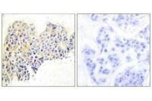 Immunohistochemical analysis of paraffin-embedded human breast carcinoma tissue using HSP90B (Ab-254) antibody. (HSP9AB1 (Ser254) 抗体)