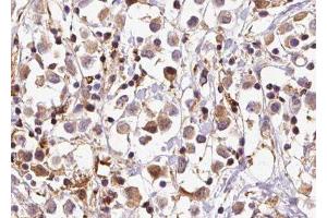 ABIN6279656 at 1/100 staining Human breast cancer tissue by IHC-P. (PIGP 抗体)