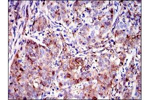 Immunohistochemical analysis of paraffin-embedded cervical cancer tissues using ANXA1 mouse mAb with DAB staining. (Annexin a1 抗体  (AA 144-248))