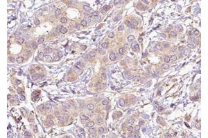 ABIN6267621 at 1/100 staining human Breast carcinoma tissue sections by IHC-P. (PTPN11 抗体  (pTyr542))