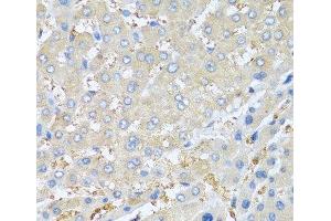 Immunohistochemistry of paraffin-embedded Human liver cancer using PPBP Polyclonal Antibody at dilution of 1:100 (40x lens). (CXCL7 抗体)