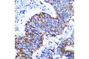 Immunohistochemistry of paraffin-embedded human colon carcinoma using COX IV Rabbit mAb (ABIN7266641) at dilution of 1:100 (40x lens). (COX IV 抗体)