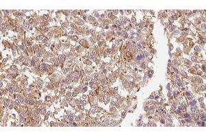 ABIN6278858 at 1/100 staining Human Melanoma tissue by IHC-P. (FGF11 抗体  (Internal Region))