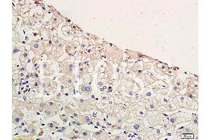 Formalin-fixed and paraffin embedded human hepatitides tissue labeled with Anti-CCR4 Polyclonal Antibody, Unconjugated (ABIN738666) at 1:200 followed by conjugation to the secondary antibody and DAB staining (CCR4 抗体  (AA 201-300))