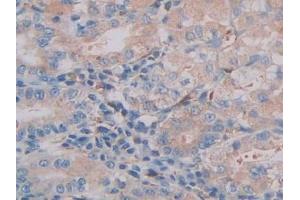 DAB staining on IHC-P; Samples: Human Stomach cancer Tissue (CTSC 抗体  (AA 231-463))