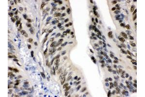 Anti-DDB1 Picoband antibody, IHC(P) IHC(P): Human Intestinal Cancer Tissue