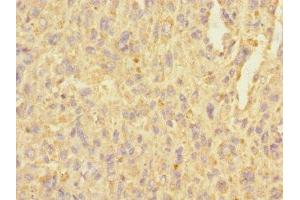 Immunohistochemistry of paraffin-embedded human melanoma using ABIN7174844 at dilution of 1:100 (C3ORF36 抗体  (AA 1-165))