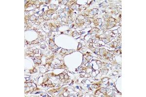 Immunohistochemistry of paraffin-embedded human mammary cancer using SLC7 antibody (ABIN7270481) at dilution of 1:100 (40x lens). (SLC7A2 抗体  (C-Term))