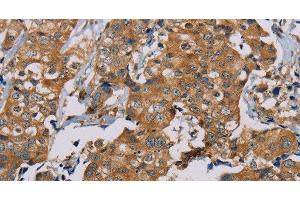 Immunohistochemistry of paraffin-embedded Human thyroid cancer using TAB3 Polyclonal Antibody at dilution of 1:35 (TAB3 抗体)