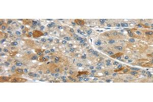 Immunohistochemistry of paraffin-embedded Human liver cancer using UPP2 Polyclonal Antibody at dilution of 1/35 (UPP2 抗体)
