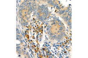 Immunohistochemistry of paraffin embedded human colon cancer using P4H (ABIN7074215) at dilution of 1:700 (400x lens) (HIF Prolyl Hydroxylase 抗体)
