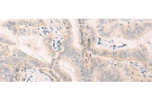 Immunohistochemistry of paraffin-embedded Human thyroid cancer tissue using ELANE Polyclonal Antibody at dilution of 1:25(x200) (ELANE 抗体)