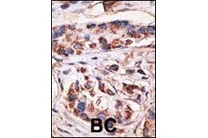 Formalin-fixed and paraffin-embedded human cancer tissue reacted with the primary antibody, which was peroxidase-conjugated to the secondary antibody, followed by DAB staining. (MAGEA1 抗体  (AA 143-173))