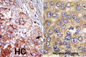 Formalin-fixed and paraffin-embedded human hepatocellular carcinoma tissue reacted with PFKFB4 polyclonal antibody  , which was peroxidase-conjugated to the secondary antibody, followed by AEC staining. (PFKFB4 抗体  (Internal Region))