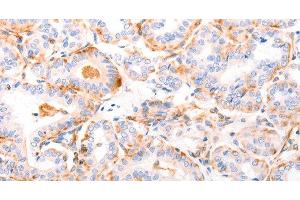 Immunohistochemistry of paraffin-embedded Human thyroid cancer using ABCA4 Polyclonal Antibody at dilution of 1:30 (ABCA4 抗体)