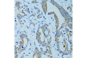 Immunohistochemistry of paraffin-embedded human colon carcinoma using KRT15 antibody (ABIN5971439) at dilution of 1/100 (40x lens). (KRT15 抗体)