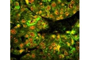 Immunofluorescence analysis of CD38 antibody with paraffin-embedded human hepatocarcinoma tissue. (CD38 抗体  (AA 241-270))
