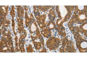 Immunohistochemistry of paraffin-embedded Human thyroid cancer tissue using PRDX5 Polyclonal Antibody at dilution 1:40 (Peroxiredoxin 5 抗体)