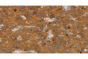 Immunohistochemistry of paraffin-embedded Human liver cancer tissue using PARP3 Polyclonal Antibody at dilution 1:40 (PARP3 抗体)