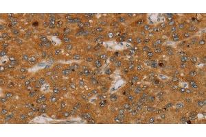 Immunohistochemistry of paraffin-embedded Human liver cancer tissue using PARP3 Polyclonal Antibody at dilution 1:40 (PARP3 抗体)