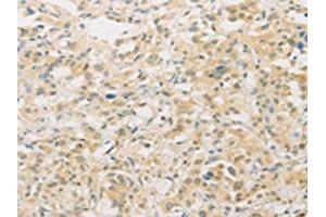 The image on the left is immunohistochemistry of paraffin-embedded Human thyroid cancer tissue using ABIN7129533(FNTA Antibody) at dilution 1/30, on the right is treated with fusion protein. (FNTA 抗体)