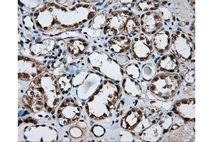Immunohistochemical staining of paraffin-embedded Adenocarcinoma of ovary tissue using anti-FAHD2A mouse monoclonal antibody. (FAHD2A 抗体)