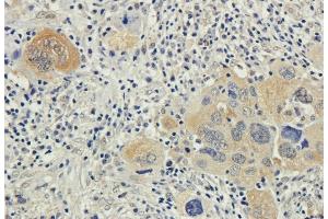 Immunohistochemical staining of human lung cancer using anti-Bax antibody.