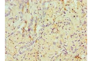Immunohistochemistry of paraffin-embedded human lung cancer using ABIN7171955 at dilution of 1:100 (ERCC2 抗体  (AA 1-300))