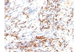 Formalin-fixed, paraffin-embedded human colon carcinoma stained with p27 antibody (DCS-72. (P27 抗体)