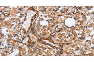 Immunohistochemistry of paraffin-embedded Human thyroid cancer tissue using BUB1 Polyclonal Antibody at dilution 1:50 (BUB1 抗体)