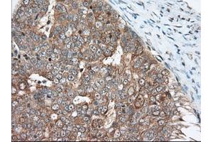 Immunohistochemical staining of paraffin-embedded Adenocarcinoma of Human breast tissue using anti-MIOX mouse monoclonal antibody. (MIOX 抗体)