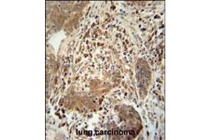 TAG antibody (Center) 10962c immunohistochemistry analysis in formalin fixed and paraffin embedded human lung carcinoma followed by peroxidase conjugation of the secondary antibody and DAB staining. (TAGAP 抗体  (AA 103-129))