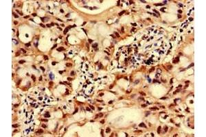 Immunohistochemistry of paraffin-embedded human lung cancer using ABIN7153896 at dilution of 1:100 (GNPNAT1 抗体  (AA 1-184))