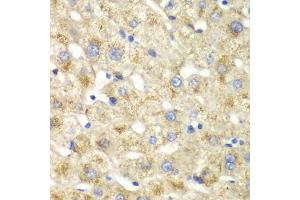 Immunohistochemistry of paraffin-embedded human liver injury using CALD1 antibody (ABIN5973102) at dilution of 1/100 (40x lens). (Caldesmon 抗体)