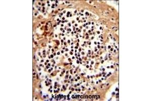 Formalin-fixed and paraffin-embedded human kidney carcinoma reacted with SERPINB7 Antibody (Center), which was peroxidase-conjugated to the secondary antibody, followed by DAB staining. (SERPINB7 抗体  (AA 108-137))