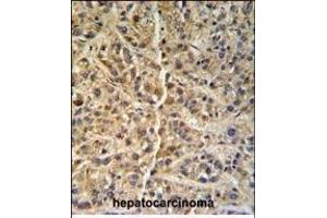 GNS Antibody (Center ) (ABIN390493 and ABIN2840852) IHC analysis in formalin fixed and paraffin embedded human hepatocarcinoma followed by peroxidase conjugation of the secondary antibody and DAB staining. (GNS 抗体  (AA 283-313))