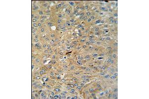 Cleaved-CASP3 (Asp175)Antibody (ABIN650861 and ABIN2839812) IHC analysis in formalin fixed and paraffin embedded human lung carcinoma followed by peroxidase conjugation of the secondary antibody and DAB staining. (Caspase 3 抗体  (Cleaved-Asp175))