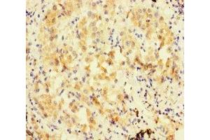 Immunohistochemistry of paraffin-embedded human lung cancer using ABIN7152480 at dilution of 1:100 (FBXL21 抗体  (AA 78-137))