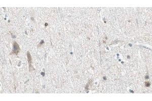 ABIN6275086 at 1/100 staining Human brain cancer tissue by IHC-P. (DZIP3 抗体  (Internal Region))