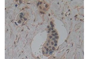 Detection of GSN in Human Breast cancer Tissue using Polyclonal Antibody to Gelsolin (GSN)