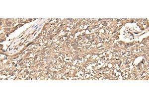 Immunohistochemistry of paraffin-embedded Human lung cancer tissue using USP21 Polyclonal Antibody at dilution of 1:50(x200)