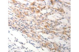 Immunohistochemical analysis of paraffin-embedded Human lung cancer tissue using at dilution 1/0. (Keratin 6B 抗体  (Internal Region))