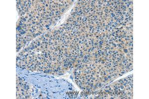 Immunohistochemistry of Human liver cancer using HID1 Polyclonal Antibody at dilution of 1:50 (HID1/DMC1 抗体)