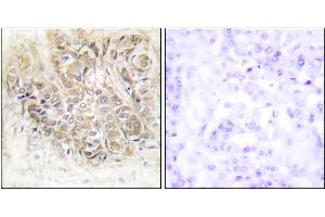 Immunohistochemistry analysis of paraffin-embedded human breast carcinoma tissue using TCTP antibody. (TPT1 抗体)