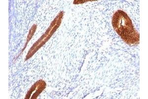 Formalin-fixed, paraffin-embedded human endometrial carcinoma stained with Cytokeratin 7 antibody (KRT7/760) (Cytokeratin 7 抗体)