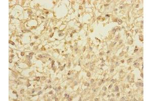 Immunohistochemistry of paraffin-embedded human melanoma using ABIN7148072 at dilution of 1:100 (CCDC113 抗体  (AA 1-200))