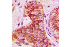 Immunohistochemical analysis of Connexin 43 staining in human breast cancer formalin fixed paraffin embedded tissue section. (Connexin 43/GJA1 抗体  (C-Term))