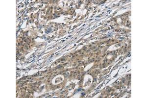 Immunohistochemical analysis of paraffin-embedded Human gastric cancer tissue using at dilution 1/30. (CACNA2D1 抗体  (Internal Region))