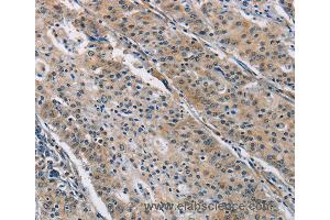 Immunohistochemistry of Human gastric cancer using BMP15 Polyclonal Antibody at dilution of 1:40 (BMP15 抗体)
